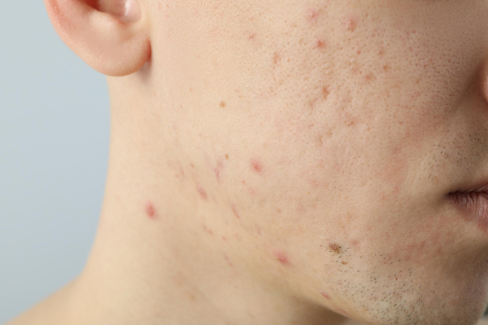 Çanakkale dermatoloji akne tedavisi