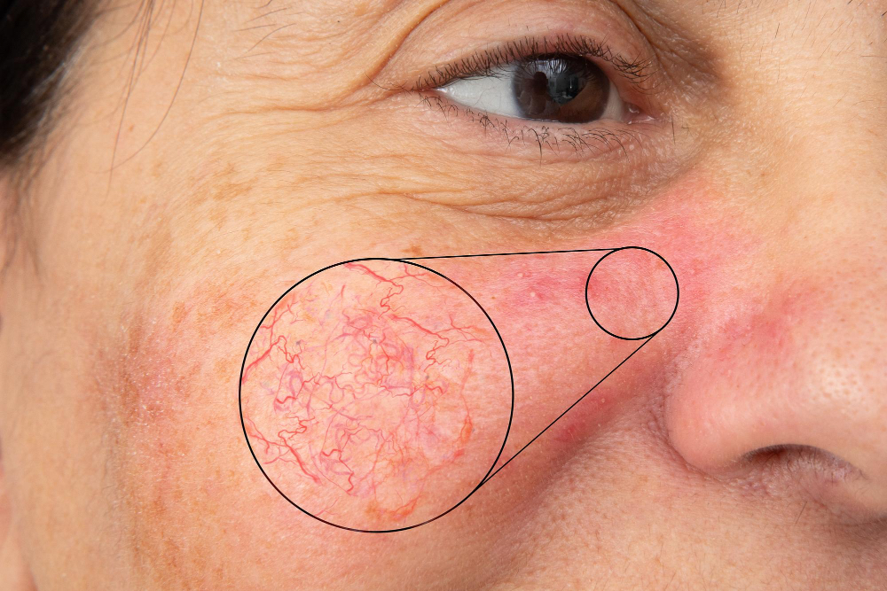 Çanakkale dermatoloji Rozasea