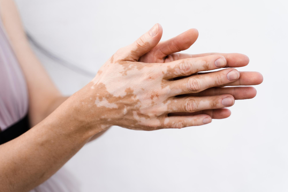 Çanakkale dermatoloji vitiligo