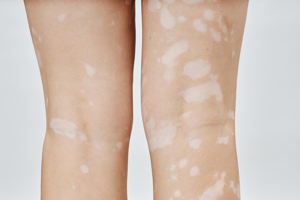 Çanakkale cilt doktoru vitiligo