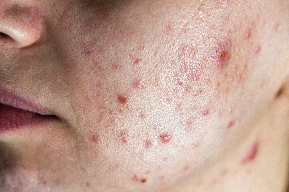 Çanakkele dermatoloji akne tedavisi