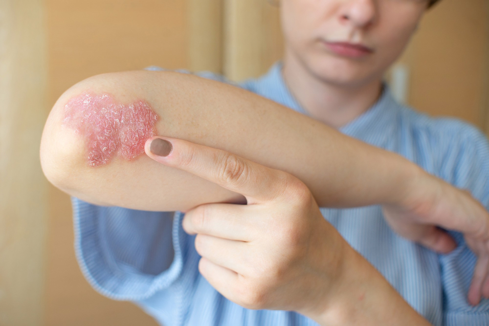 Çanakkale dermatoloji sedef hastalığı