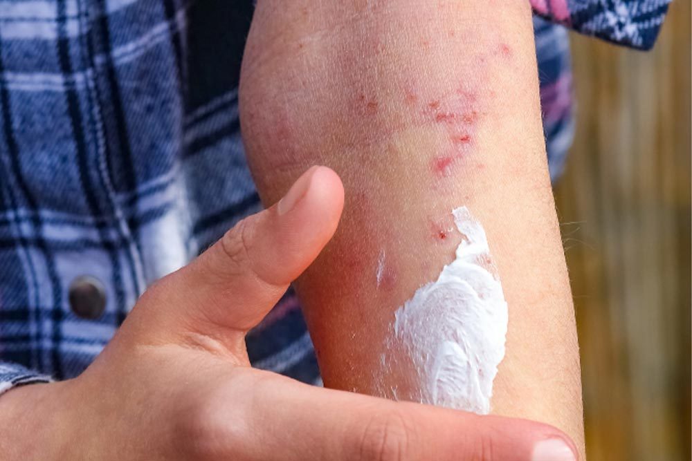 Çanakkale dermatoloji egzama tedavisi Çanakkale dermatoloji egzama tedavisi